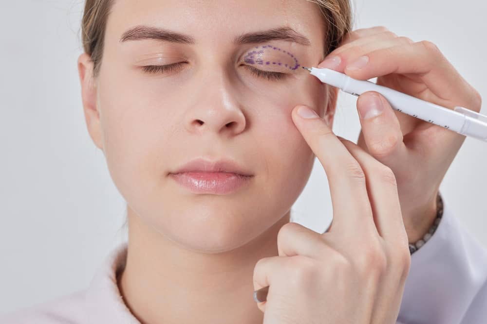 Göz Kapağı Estetiği (Blefaroplasti)